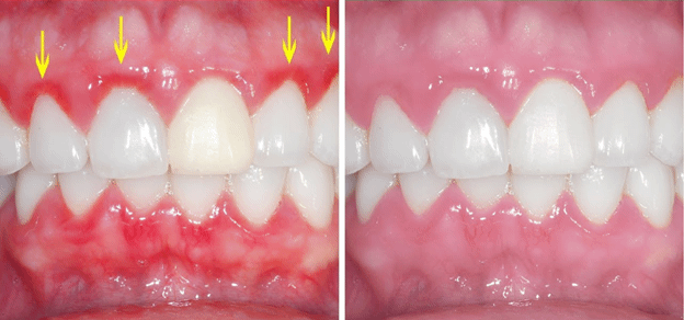 https://www.smilestudiosredmond.com/wp-content/uploads/2020/12/periodontal-gum-diseaes.png